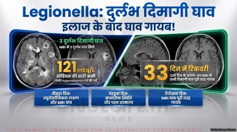 स्प्लेनियम, कॉर्टेक्स और व्हाइट मैटर में घाव; जानिए जापानी डॉक्टरों की केस स्टडी :Infectious Disease & Neurology Updates